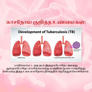 Illustration showing the progression of tuberculosis in the lungs.