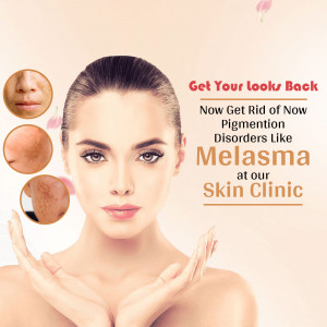 Woman with clear skin promoting melasma treatment