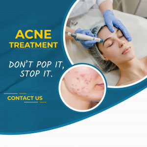 Close-up of a woman receiving acne treatment with a microneedling pen, with a before and after image.