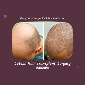 Hair transplant surgery before and after results showing hair restoration.