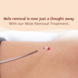 Mole removal treatment using a specialized device on skin.