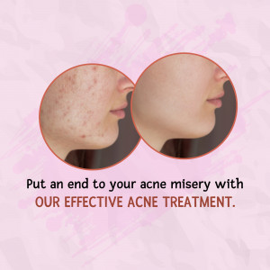 Before and after image showcasing acne treatment results