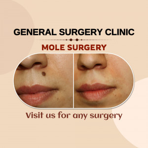 Before and after image of mole removal surgery
