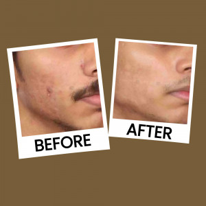 Before and after photo showing improvement in acne-prone skin.