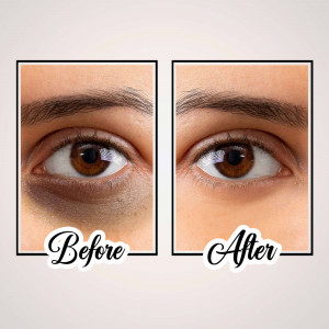 Close-up of eyes showing before and after results of under eye treatment.