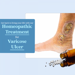 Homeopathic Treatment For Varicose Ulcer Promotional Banner For Telegram
