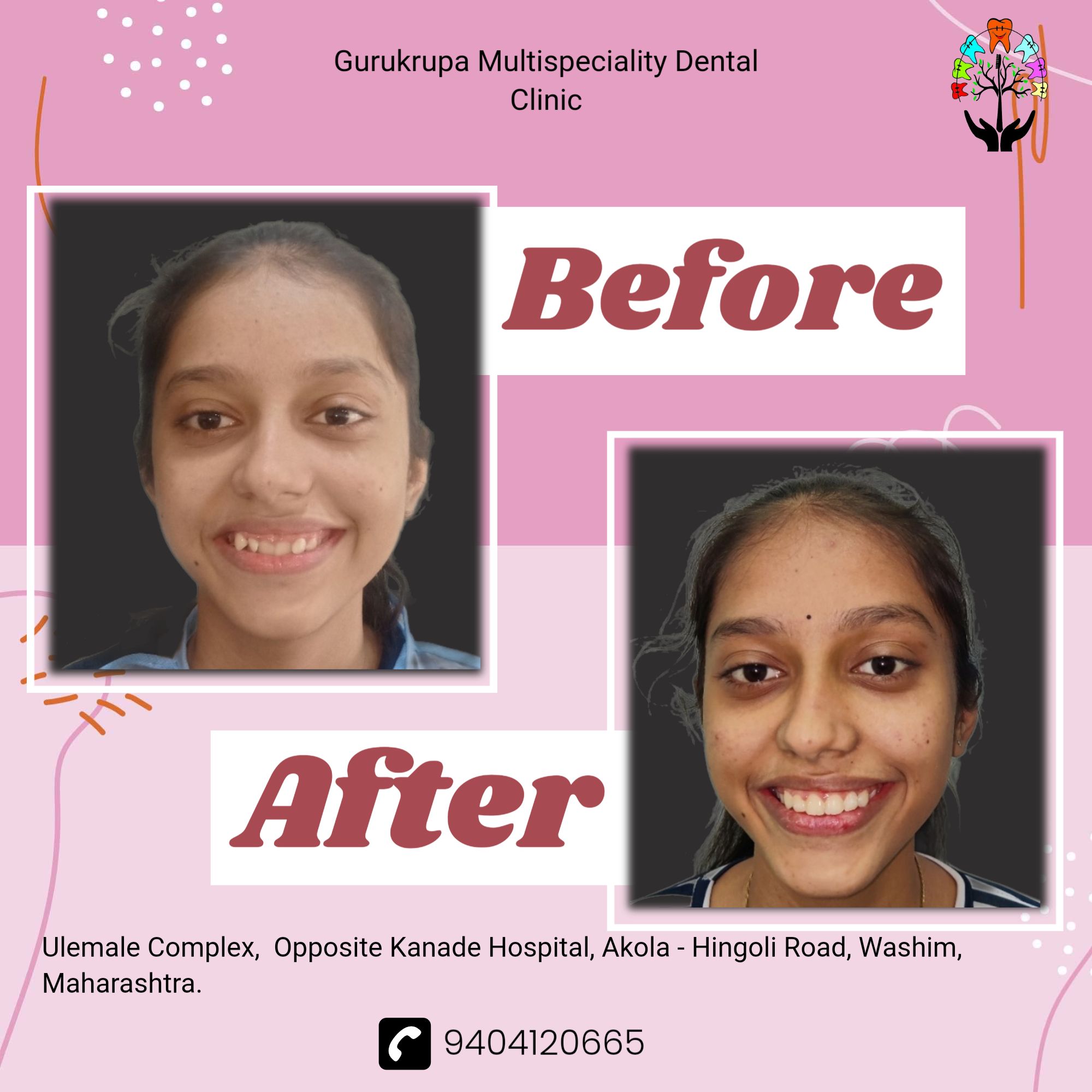 Our specialized Orthodontic Clinic in Washim has the ability to correct your smile at your convenience.